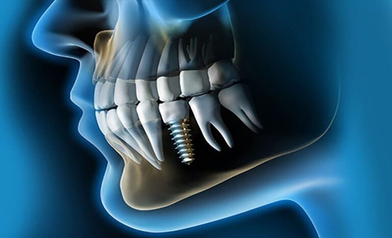 Rehabilitación Sobre Implantes Dentales - Clínica Dental Alfa