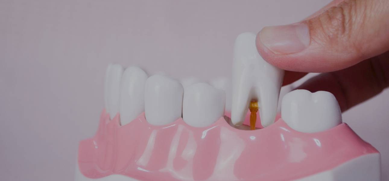 Extracciones dentales : Porque acudir a nosotros