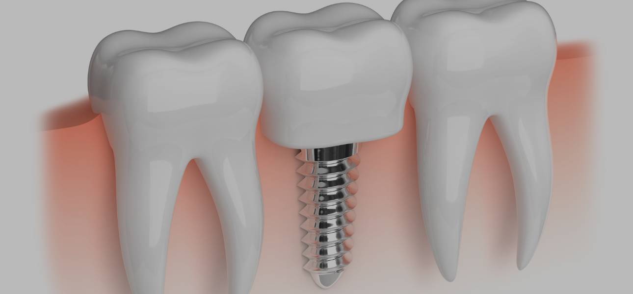 5 razones por las que recomendamos los implantes dentales