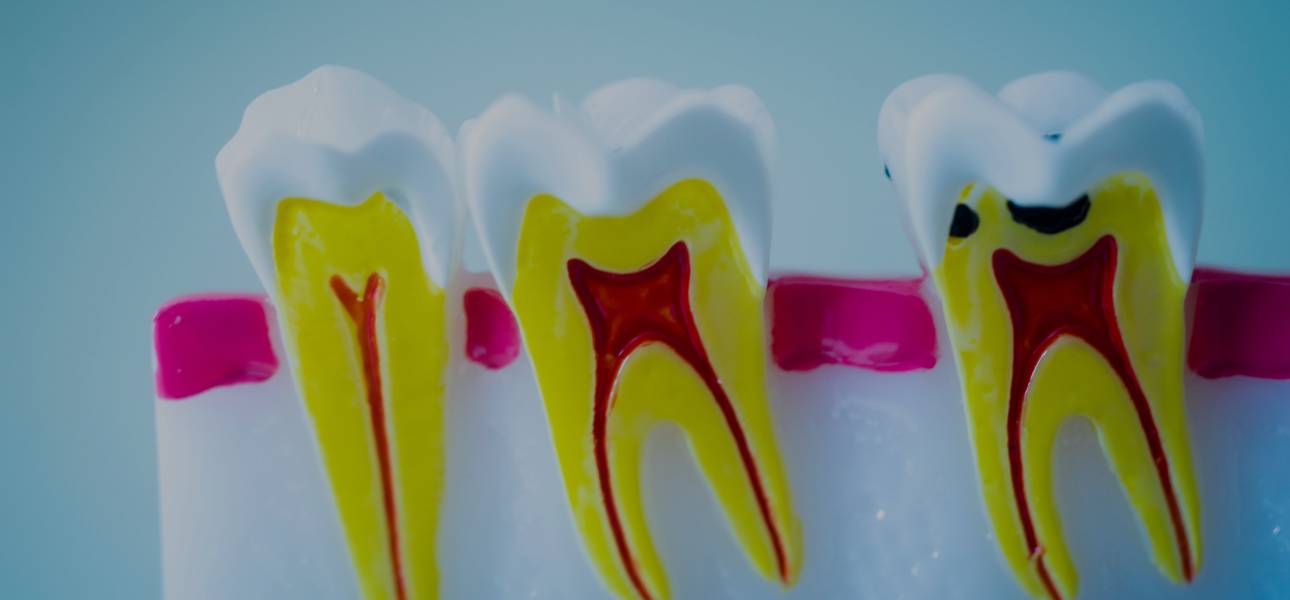 Tratamiento conducto : La importancia de salvar un diente