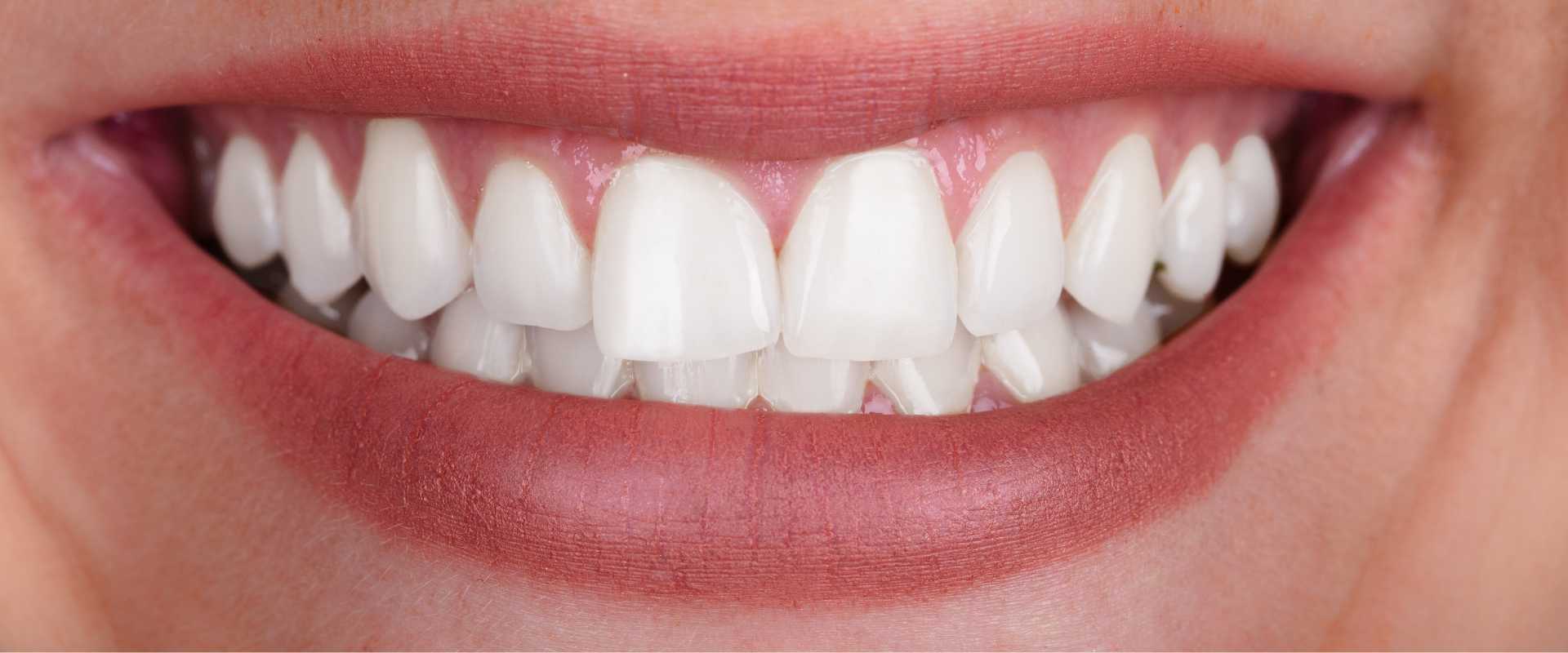 Sonrisa después del blanqueamiento dental